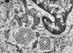 M,33y. | blood - hairy cell leukemia- ribosome-lamella complexin tricholeukocyte